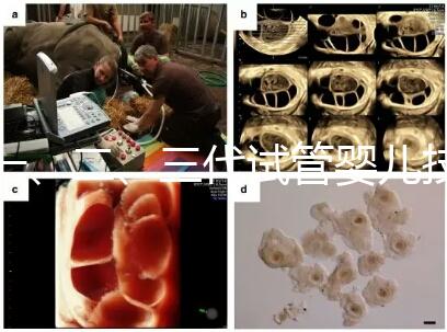 一、二、三代試管嬰兒技術的區別，看完你就知道了！