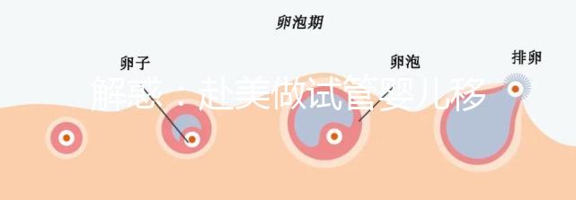 解惑:赴美做試管嬰兒移植兩個囊胚-生雙胞胎的概率