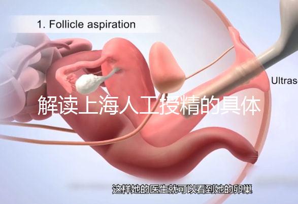 解讀上海人工授精的具體過程，會不會痛看醫生怎么說？