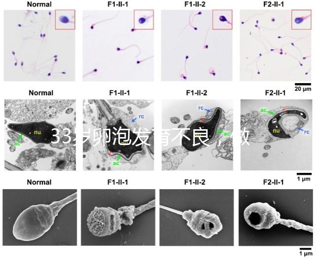33歲卵泡發育不良，做試管黃體期促排方案失敗怎么辦？